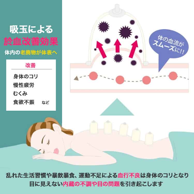 吸玉療法の効果が分かるイラスト資料